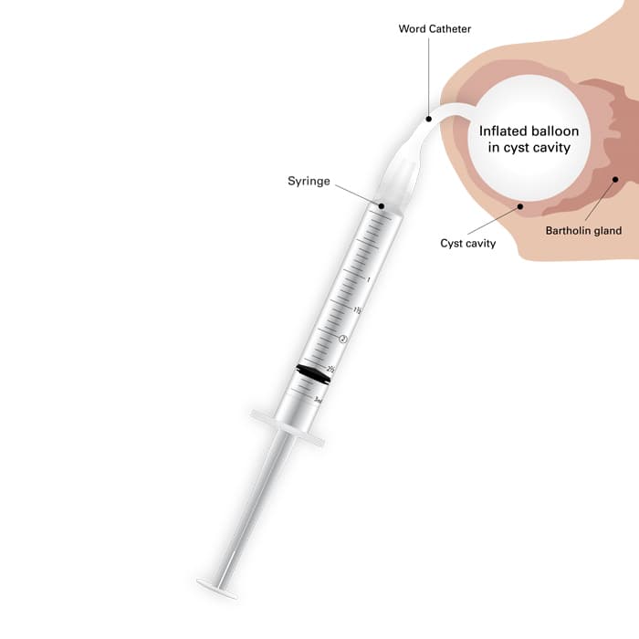 Word Bartholin Catheter Kit - thumbnail 3