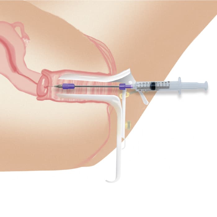 Reach Kit™ Cervical Block Procedure Kit - thumbnail 3
